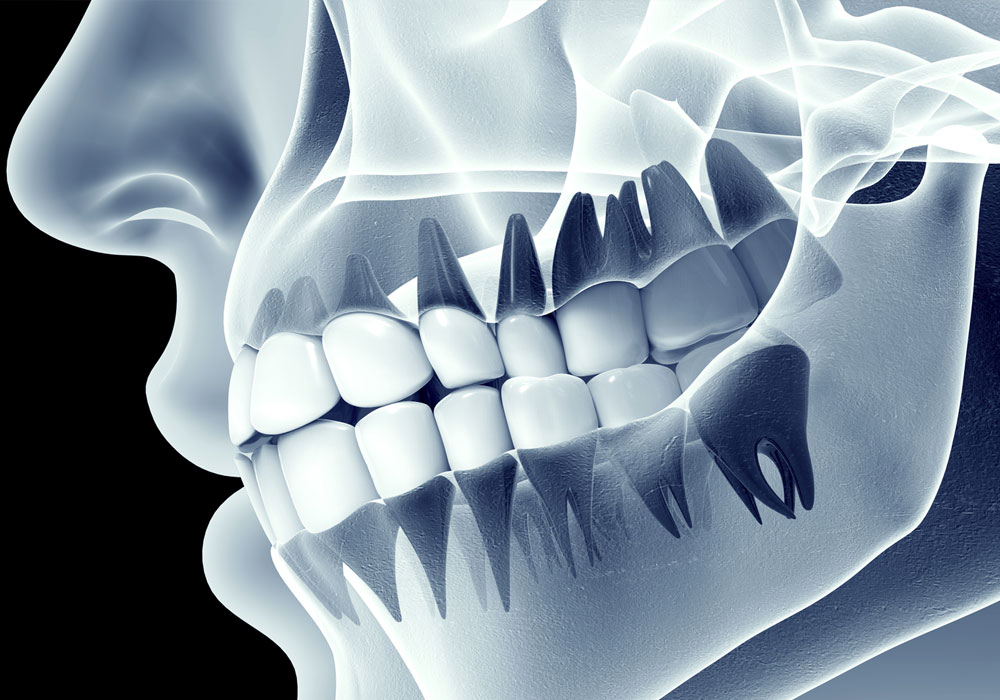 Understanding Dental X-rays A Glimpse Beneath the Surface