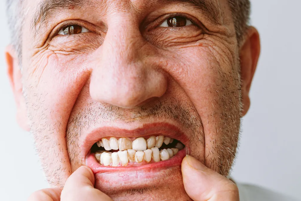 What is Periodontitis?